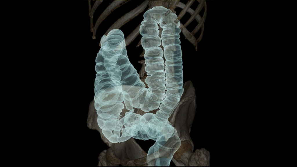 A CT colonography scan