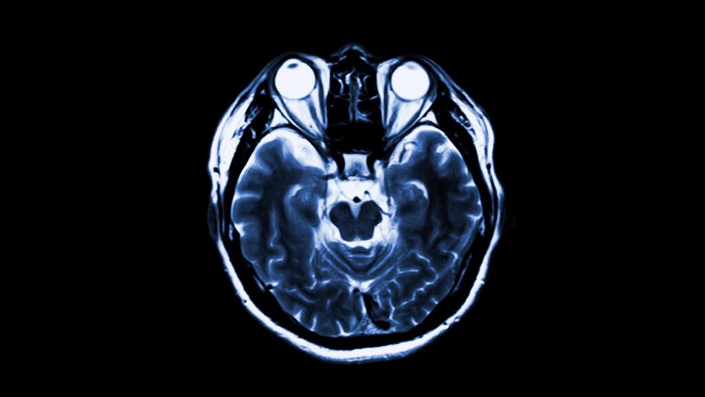 MRI of the head and eyes