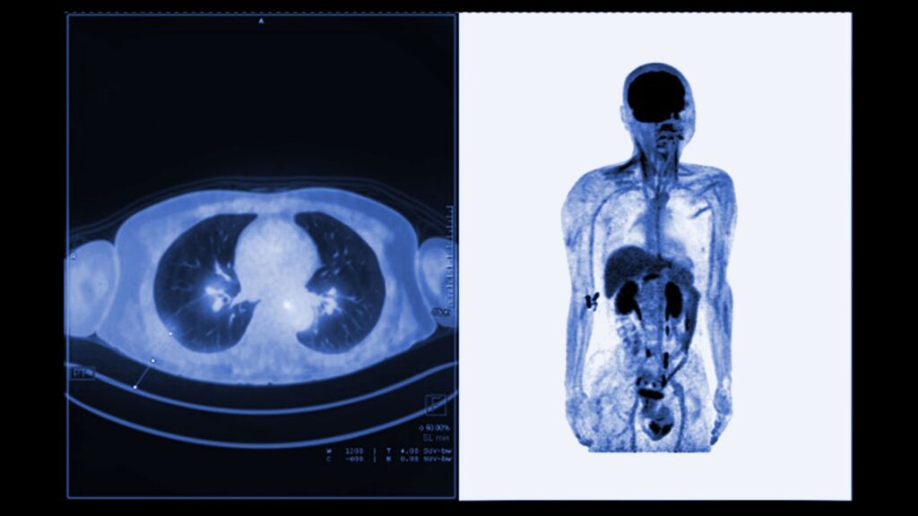 PET scan of the lungs