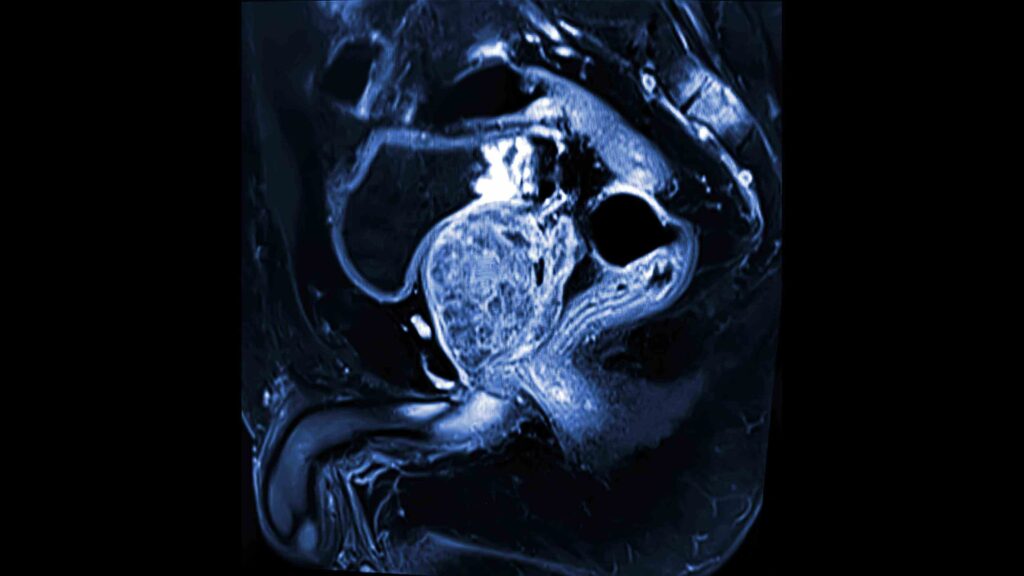 MRI scan of a prostate