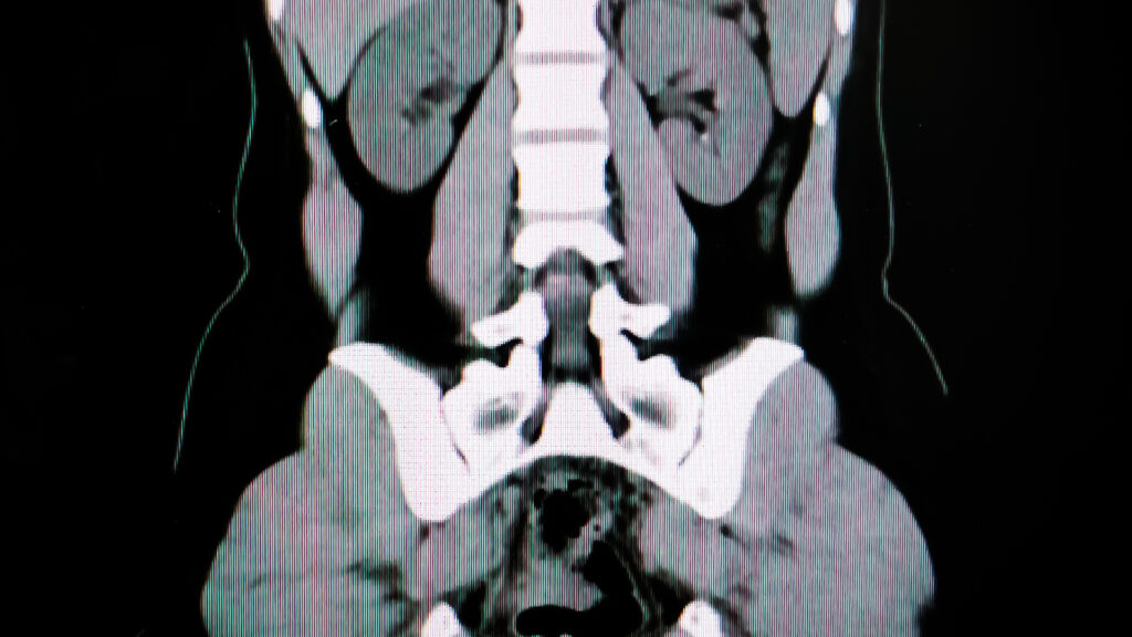 CT scan of urinary system used in a bladder cancer diagnosis.