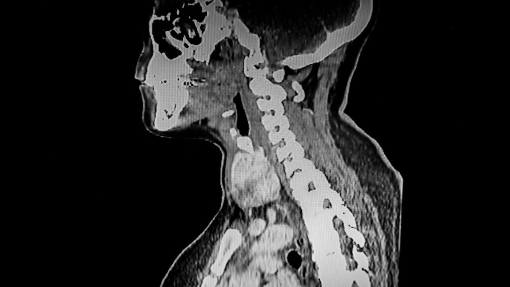 CT scan of the neck to determine thyroid cancer management.